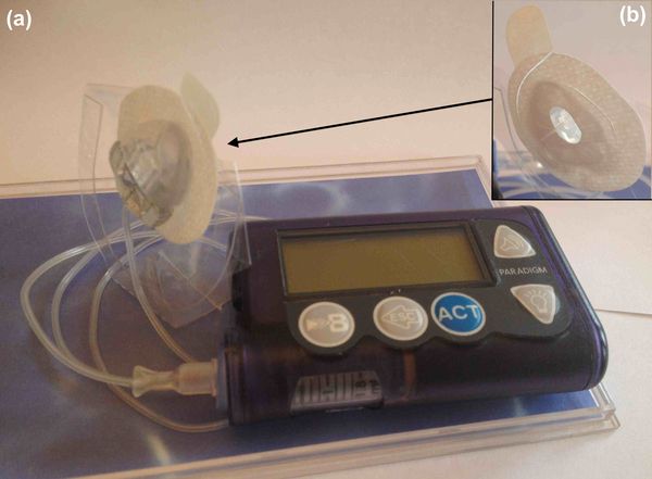 Durability of the Continuous Subcutaneous Insulin Infusion (CSII) Patch Adhesive