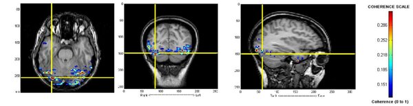 Functional Network Connectivity: Possible Biomarker for Autism Spectrum Disorders (ASD)