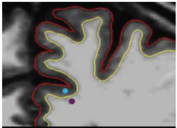 Correlations between Gray-White Matter Contrast in Prefrontal Lobe Regions and Cognitive Set-Shifting in Healthy Adults 