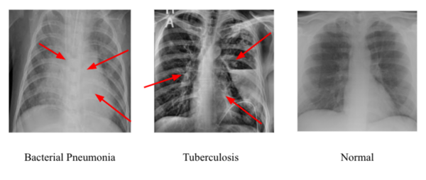 Determining the best convolutional neural network for identifying tuberculosis and pneumonia in chest x-rays