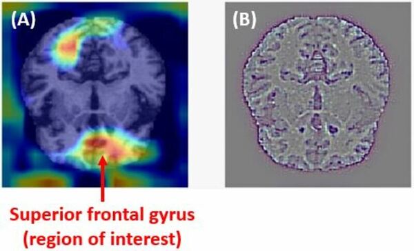 A novel approach for early detection of Alzheimer’s disease using deep neural networks with magnetic resonance imaging