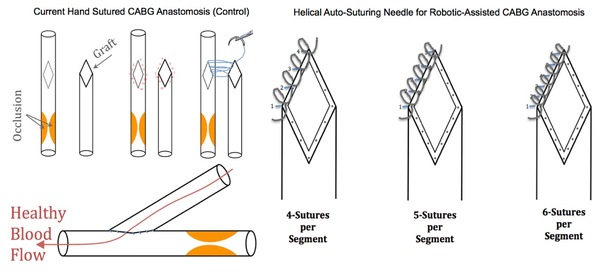 A Novel Method for Auto-Suturing in Laparoscopic Robotic-Assisted Coronary Artery Bypass Graft (CABG) Anastomosis 