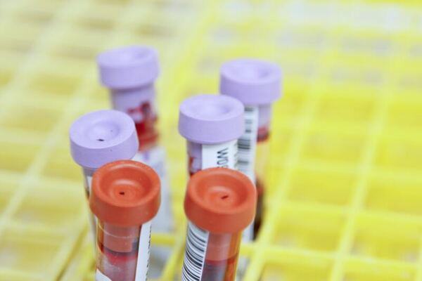Interleukin family (IL-2 and IL-1β) as predictive biomarkers in Indian cancer patients: A proof of concept study