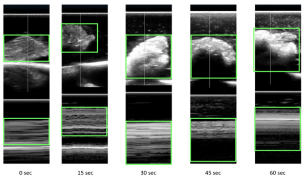 Identification of microwave-related changes in tissue using an ultrasound scan