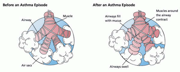 <em>Pichia kudriavzevii</em> Yeast Exposure Increases the Asthmatic Behavior of Alveolar Epithelial Cells <em>In Vitro</em>