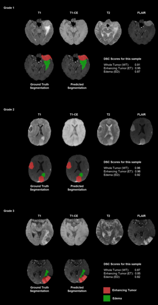 Evaluating the clinical applicability of neural networks for meningioma tumor segmentation on 3D MRI