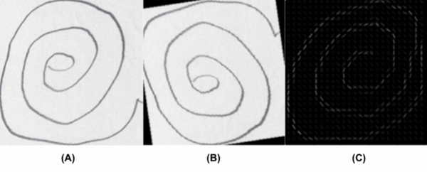 A HOG feature extraction and CNN approach to Parkinson’s spiral drawing diagnosis