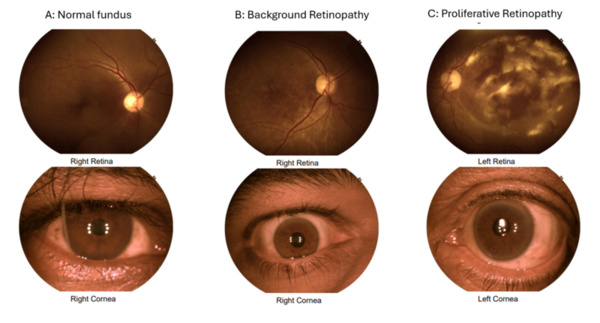 Machine learning for retinopathy prediction: Unveiling the importance of age and HbA1c with XGBoost