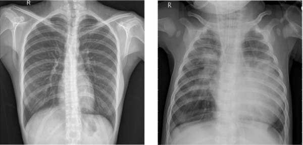 Convolutional neural network-based analysis of pediatric chest X-ray images for pneumonia detection