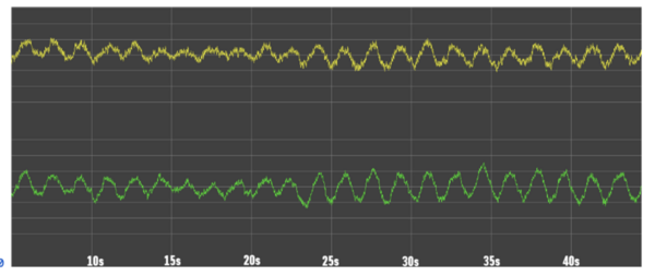 Temporal characterization of electroencephalogram slowing activity types