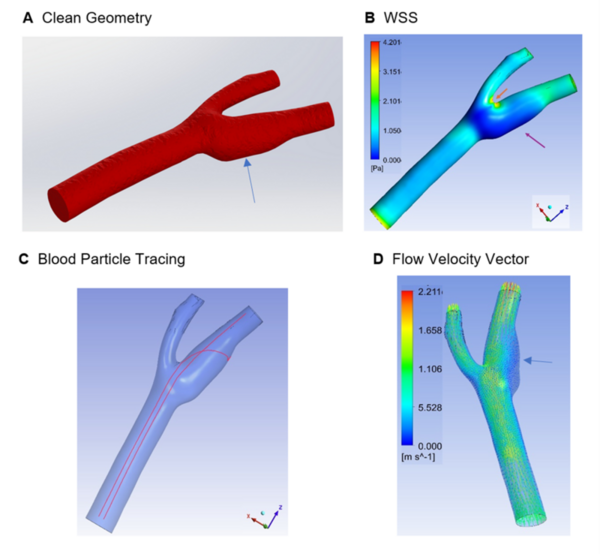 Enhanced brain arteries and aneurysms analysis using a CAE-CFD approach