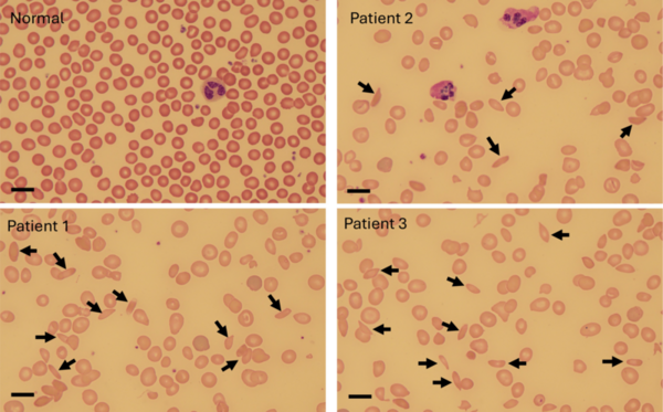 Predicting sickle cell vaso-occlusion by microscopic imaging and modeling