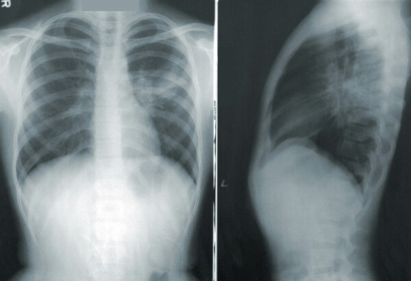 Cover photo for Lung region complexity affects Grand-CAM and Deep Taylor outcomes in pneumonia predictions