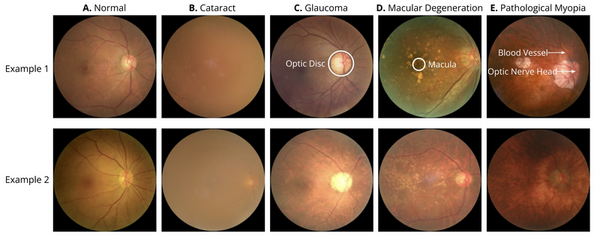 Cover photo for Retinal biomarkers for the detection of neurological disease using deep learning