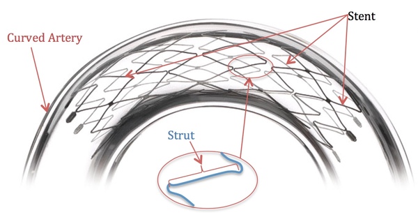 Cover photo for Comparing the Effect of Stent Geometry on Blood Flow Rate of Curved Coronary Artery Stenosis