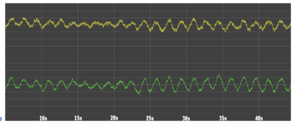 Cover photo for Temporal characterization of electroencephalogram slowing activity types