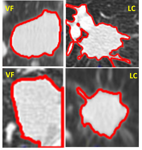 Cover photo for The use of computer vision to differentiate valley fever from lung cancer via CT scans of nodules