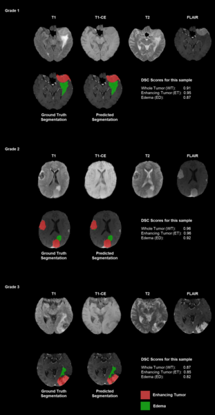 Cover photo for Evaluating the clinical applicability of neural networks for meningioma tumor segmentation on 3D MRI