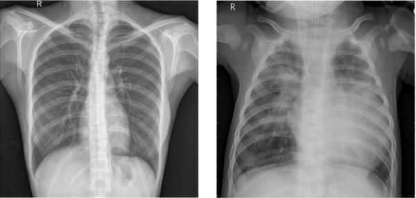 Cover photo for Convolutional neural network-based analysis of pediatric chest X-ray images for pneumonia detection