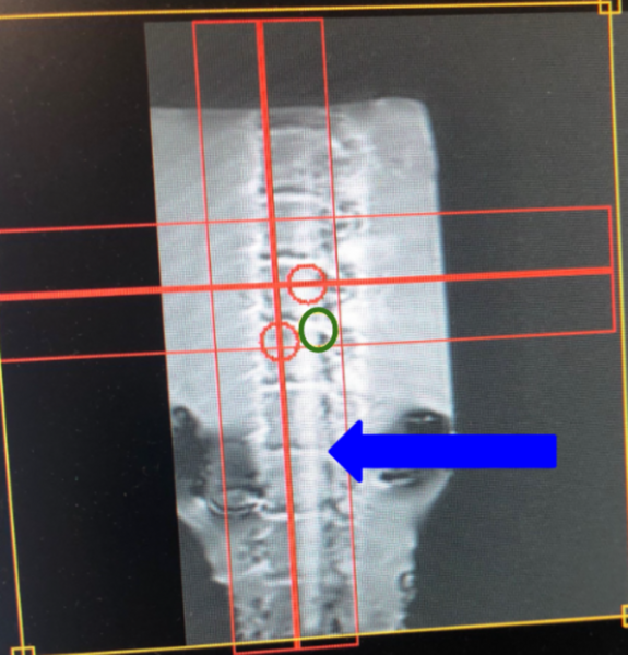 Cover photo for Utilizing a novel T1rho method to detect spinal degeneration via magnetic resonance imaging