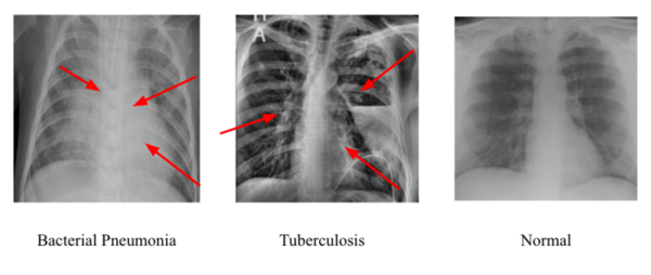 Cover photo for Determining the best convolutional neural network for identifying tuberculosis and pneumonia in chest x-rays