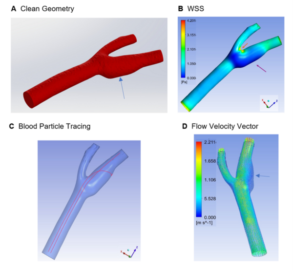 Enhanced brain arteries and aneurysms analysis using a CAE-CFD approach ...