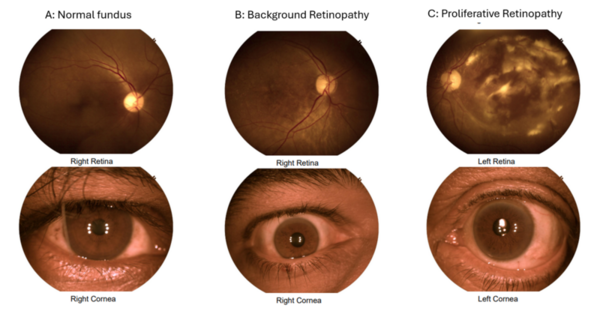 Cover photo for Machine learning for retinopathy prediction: Unveiling the importance of age and HbA1c with XGBoost